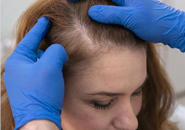 Workshop de Alopecia y anexos Cutáneos